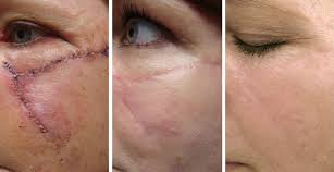 Scar Revision